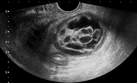 Ovarian Dermoid Cyst | Dermoid cyst, Cysts, Ovarian