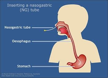 Kids Health Information : Nasogastric tubes