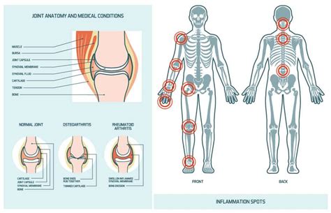 Osteoarthritis Treatment - Returning to Healthy Joint Function - SpineOne