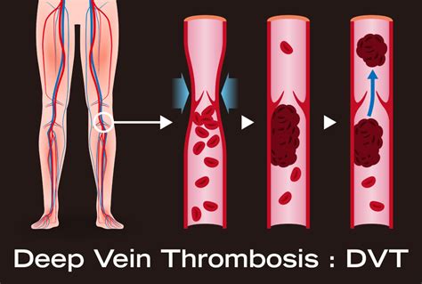 Can a DVT Cause Pain without Swelling or Redness? » Scary Symptoms