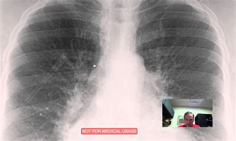 CXR Pulmonary Vascular Congestion Discussed by Radiologist.mp4 - YouTube