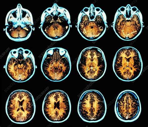 38+ Anatomy Brain On Mri Background