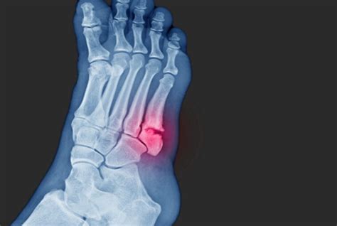 Jones Avulsion Fracture