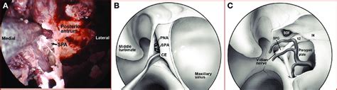 Endonasal approach to pterygopalatine and infratemporal fossae. A,... | Download Scientific Diagram