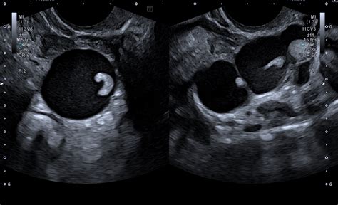 Beware of this hydrosalpinx-mimic on ultrasound - ScholarMD