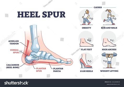 Plantar Spur Human Foot Bones Vector Illustration Isolated On A White ...