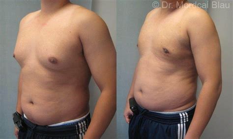 Pseudogynecomastia - Before and After Photos ⋆ Gynecomastia USA