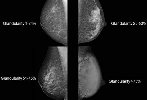 What Is Fibroglandular Density