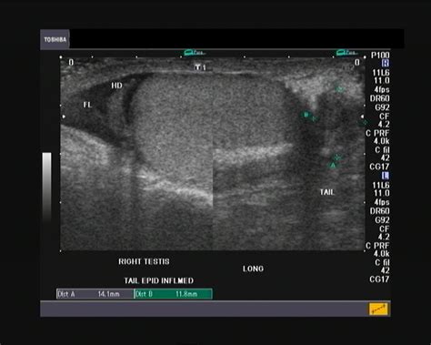 Ultrasound and Color Doppler videos: Focal epididymitis: