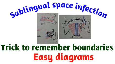 Sublingual space infection - YouTube