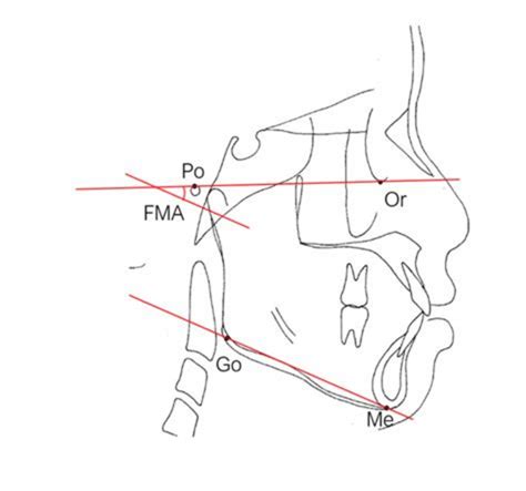 The Frankfort-mandibular plane angle (FMA). The FMA is formed by the ...