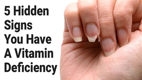 5 Hidden Signs You Have A Vitamin Deficiency