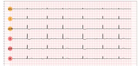 Third-degree AV block (3rd degree AV block, AV block 3, AV block III) – Cardiovascular Education