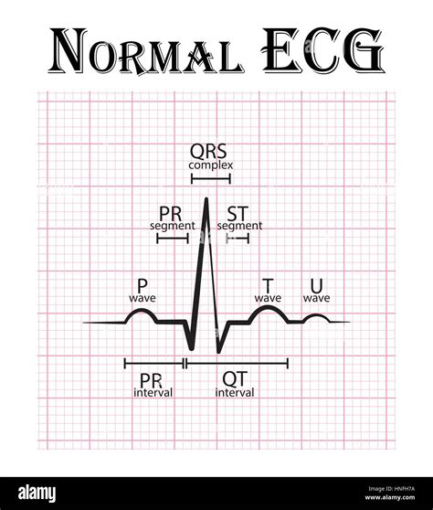 Normal Ecg Complex