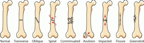 How Easy is It to Break a Bone - Brown Alit1974