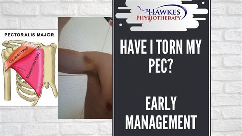 Have I torn my Pec? Early management of a Pec tendon tear - YouTube