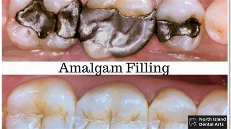 All about amalgam dental fillings - Northislanddental