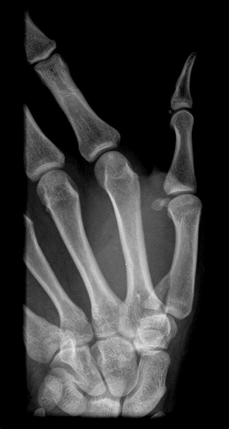 Classification of the Bennett's fracture - wikidoc