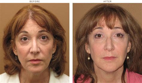 Sculptra - Before and After Pictures * | Dr Turowski - Plastic Surgery Chicago