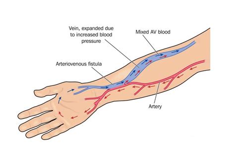 Arterio-Venous Fistula: How To Look After It - Healthtips by TeleMe