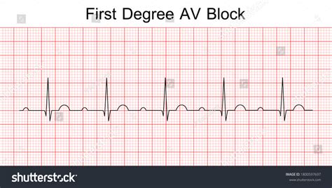 Electrocardiograma