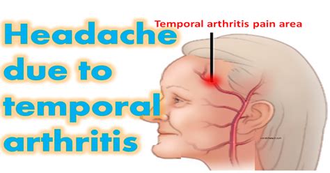 Temporal Arteritis Symptoms Treatments Causes