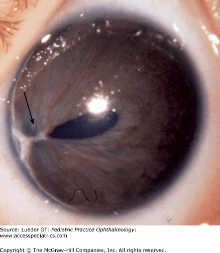 Disorders of the Iris and Pupil | Ento Key