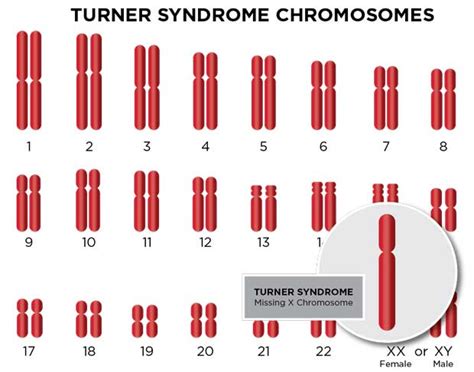 Turner Syndrome Diagnosis & Treatment | Cardinal Glennon