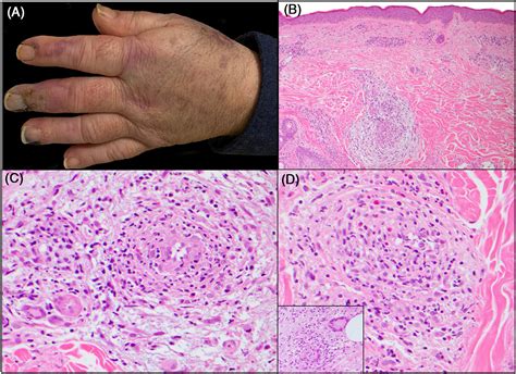 Eosinophilic granulomatosis with polyangiitis: Cutaneous clinical and histopathologic ...