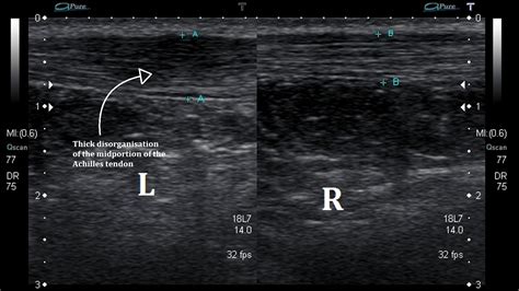 Ultrasound Images of Achilles Tendinopathy - Ankle, Foot and Orthotic Centre