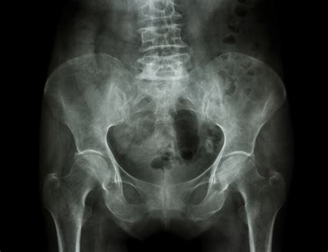 Understanding Osteoporosis: Prevention, Screening, and Treatment