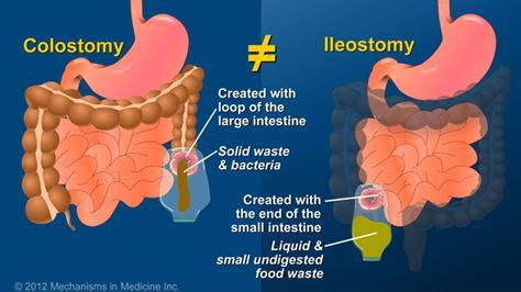 What is an Ileostomy? | Ileostomy, Colostomy, Ulcerative colitis