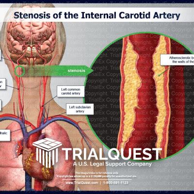 Internal Carotid Artery