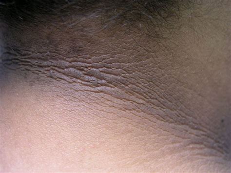 Acanthosis - Definition of Acanthosis