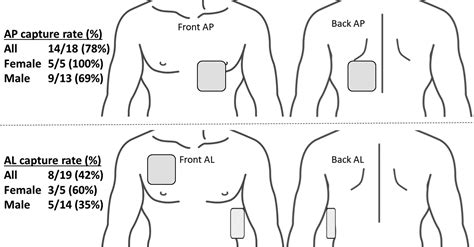 Anteroposterior Pacer Pad Position Is More Likely to Capture Than ...