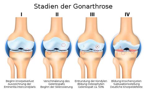 Gonarthrose - Schmerzfrei mit der richtigen Therapie