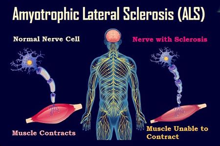 Herbal Remedies for ALS (Amyotrophic Lateral Sclerosis) - Dr. Vikram's ...