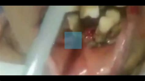 Maggot Infested Mouth - YouTube