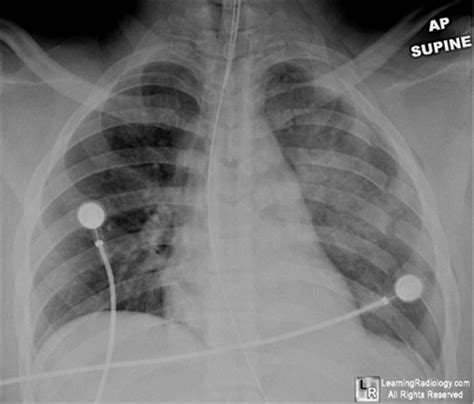 Flail Chest - Pulmonary - Medbullets Step 2/3