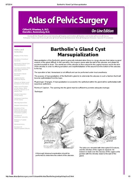 Bartholin's Gland Cyst Marsupialization | Vagina | Surgery