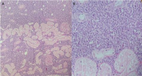 -Feline lymphoma, kidney. (A) Infiltration of neoplastic cells,... | Download Scientific Diagram