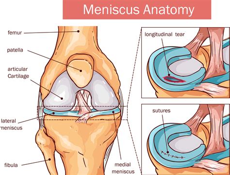 What Is a Meniscus Tear? - Los Angeles, CA | C. Thomas Vangsness, Jr., M.D.