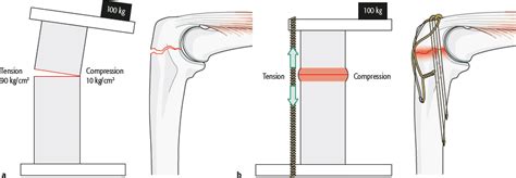 3.2.3 Tension band principle | Musculoskeletal Key