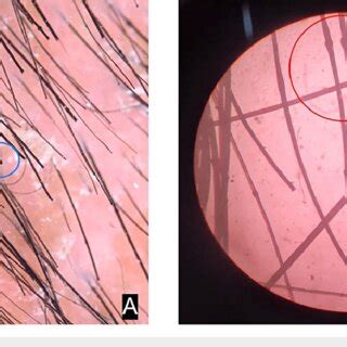 Bamboo shaft hair / trichorhexis invaginata demonstrated (red) on... | Download Scientific Diagram