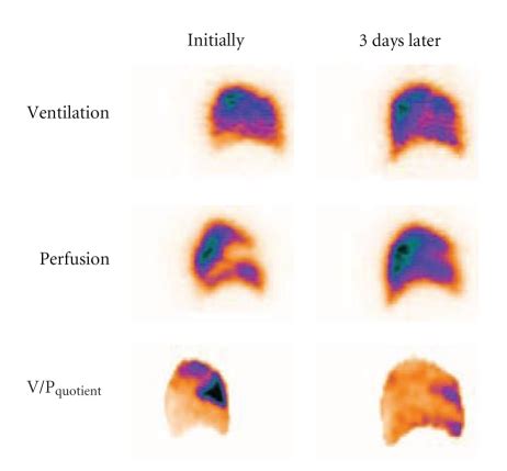 Sagittal slice in patient with segmental PE. Perfusion defect in ...