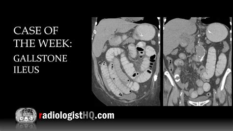 Case of the Week: Gallstone Ileus (X-ray & CT) - YouTube