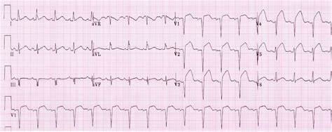 Anterior Wall Myocardial Infarction ECG