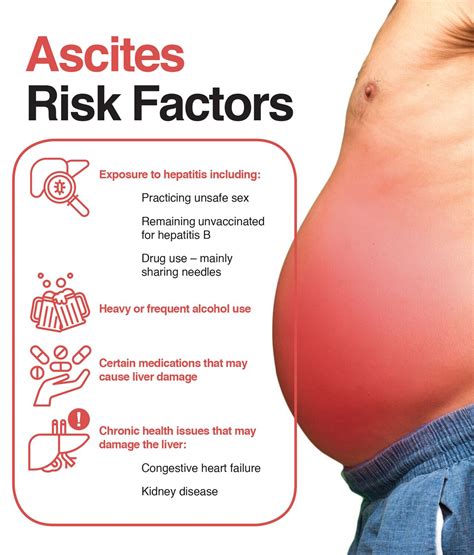 Ascites: Symptoms, Causes and Treatment for Fluid in the Abdomen – The ...