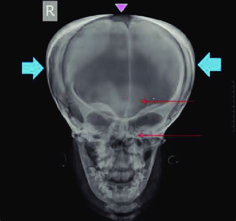 Open anterior fontanelle (pink triangle); non-pneumatized: frontal and ...