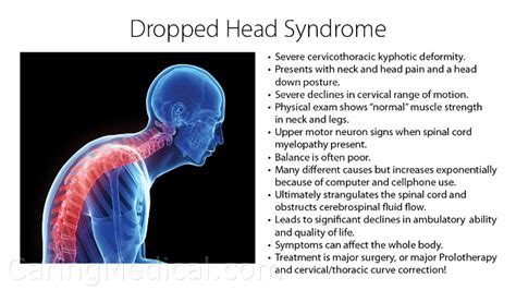 Dropped Head Syndrome